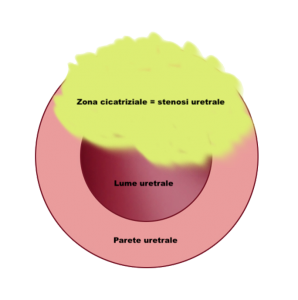 Cicatrice estesa lume uretrale - Fig. 8