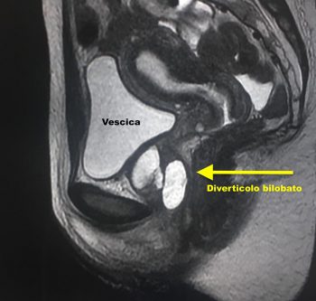 Diverticoli uretrali - Fig. 7