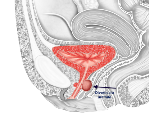 Diverticolo uretrale - Fig. 1