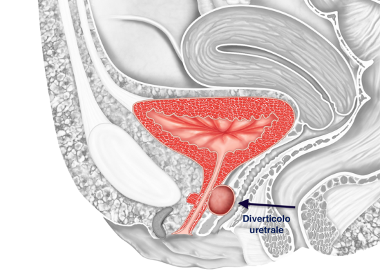 Diverticolo uretrale - Fig. 1