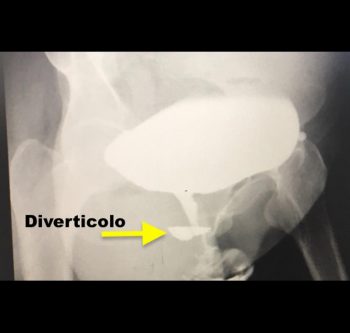 Diverticoli uretrali - Fig. 3
