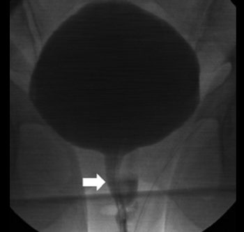 Diverticoli uretrali - Fig. 4