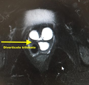 Diverticoli uretrali - Fig. 8