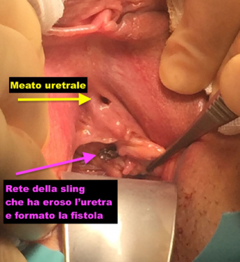 Rimozione fistole uretro vaginali - Fig. 1