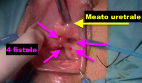 Fistole uretro-vaginali - Fig. 3