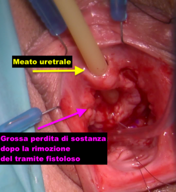 Asportazione fistole uretro vaginali Fig. 4