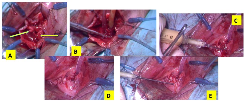 Intervento diverticolo uretrale - Fig. 9