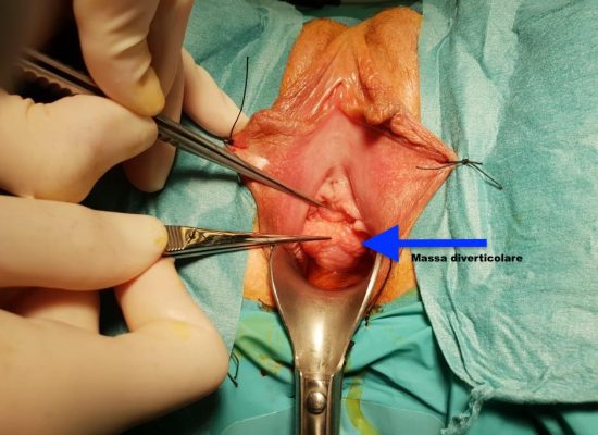 Massa diverticolare - Fig. 2