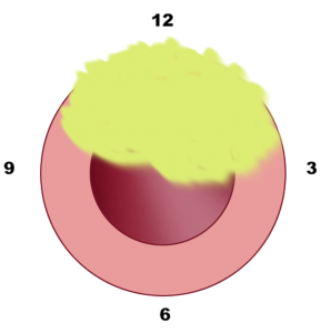Sede stenosi uretrale - Fig. 9