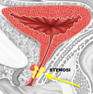 Stenosi uretrale femminile
