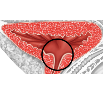 Uretra collo vescicale - Fig. 3