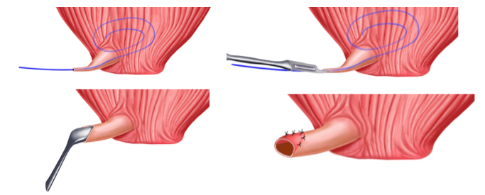 Uretroplastica dorsale stenosi distali - Fig. 12