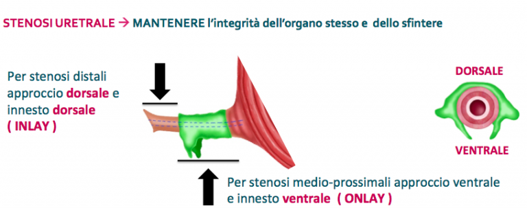 Uretroplastica: il concetto di risparmio dell'organo e degli sfinteri - Fig. 11