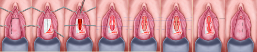 Uretroplastica ventrale per stenosi medio-prossimali - Fig. 13