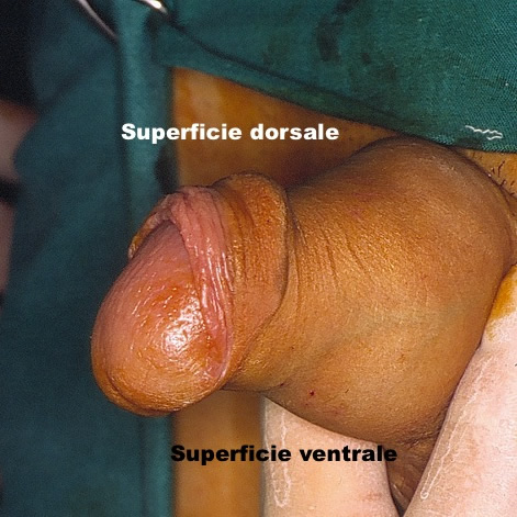Fig. 4 - "Prepuzio a cappuccio di frate"