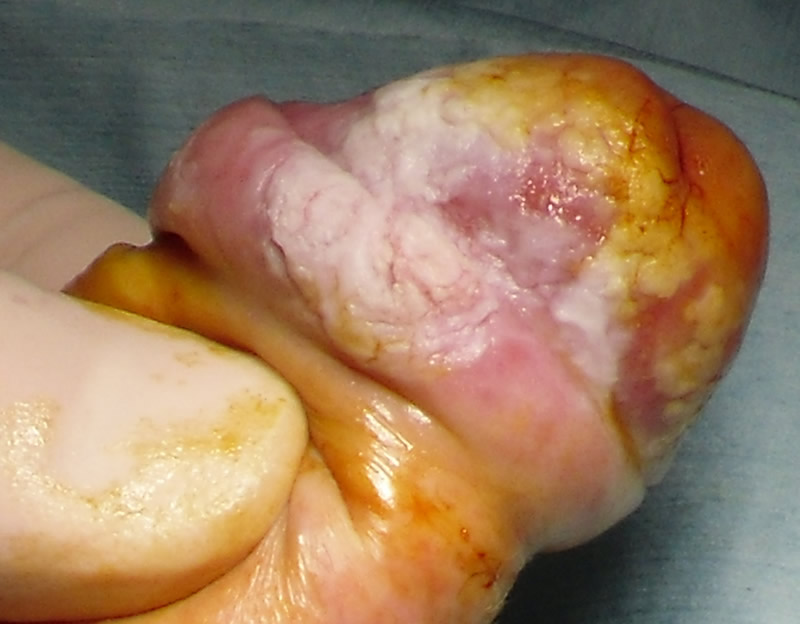 Tumore pene - Fig. 1
