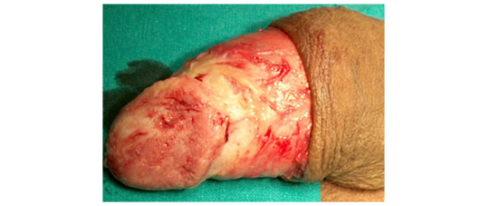 Chirurgia ricostruttiva tumore pene - Fig. 10