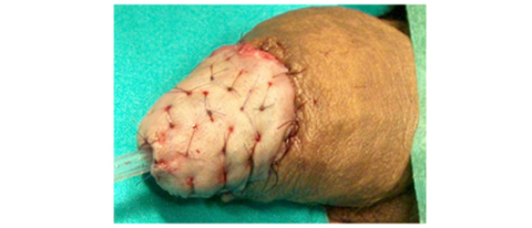 Chirurgia ricostruttiva tumore pene - Fig. 15