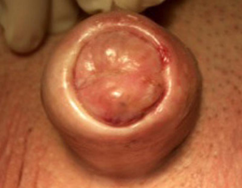 Pene con fimosi da Lichen Sclerosus - Fig. 2