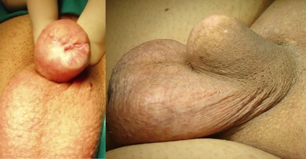 Moncone penieno dopo penectomia parziale - Fig. 3, 4