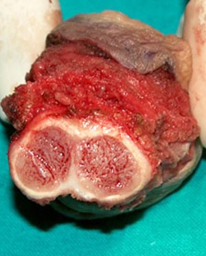 Penectomia parziale e ricostruzione plastica del neoglande - Fig. 31