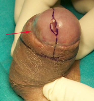 Carcinoma in situ - Fig. 5