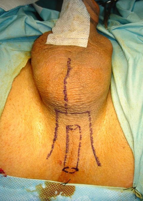 Rimozione stent uretrale - Fig. 3