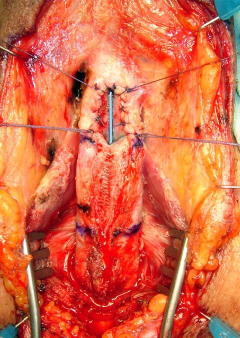 Rimozione stent uretrale - Fig. 4