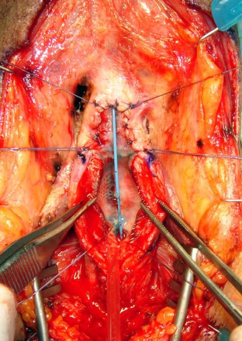 Rimozione stent uretrale - Fig. 5