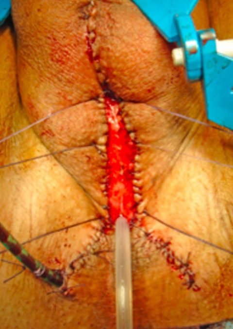 Rimozione stent uretrale - Fig. 7