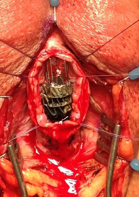 Rimozione stent uretrale - Fig. 8