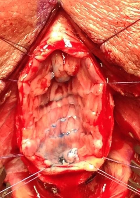 Rimozione stent uretrale - Fig. 9