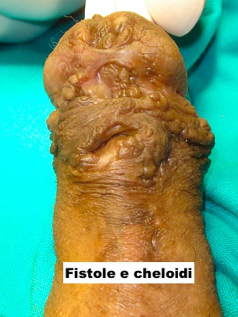 Fistole e cheloidi ipospadia - Fig. 10