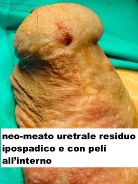 Meato uretrale residuo ipospadico - Fig. 11