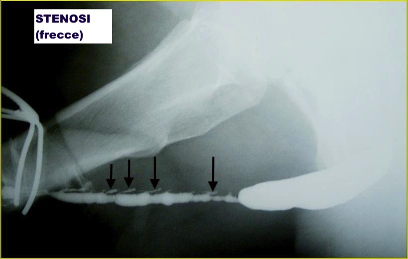 Lichen sclerosus - Fig. 5
