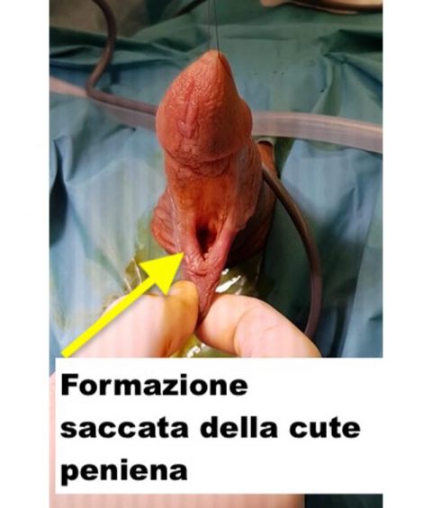 Ricostruzione del pene - Fig. 8