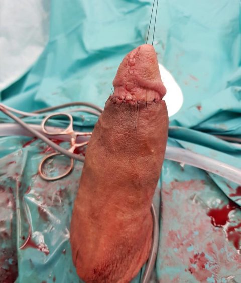 Ricostruzione del pene - Fig. 9