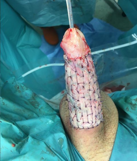 Ricostruzione del pene - Fig. 6
