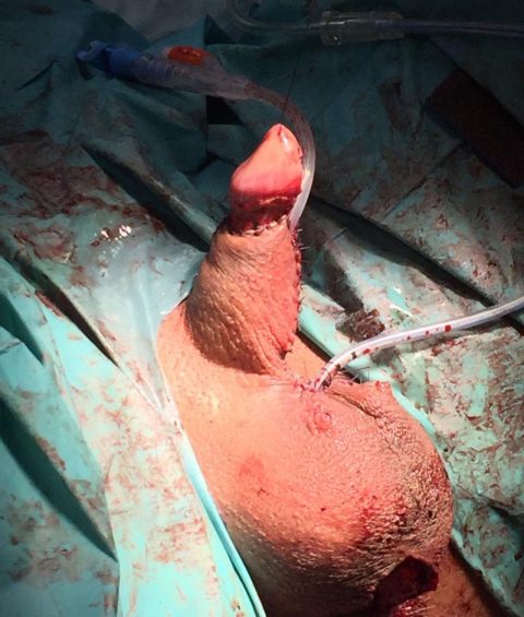 Ricostruzione del pene - Fig. 3