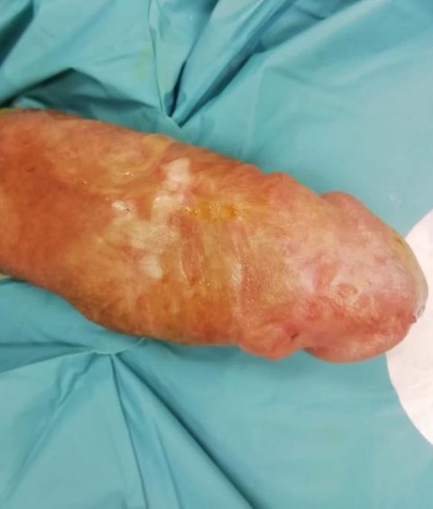 Ricostruzione del pene - Fig. 10