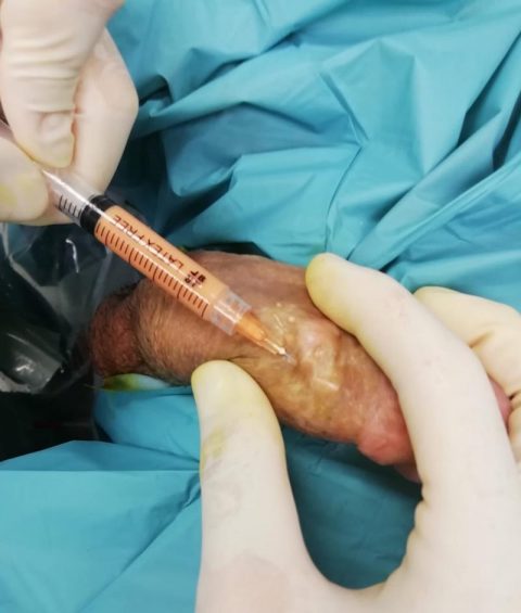 Ricostruzione del pene - Fig. 11