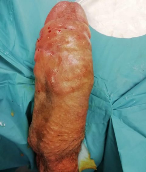 Ricostruzione del pene - Fig. 12