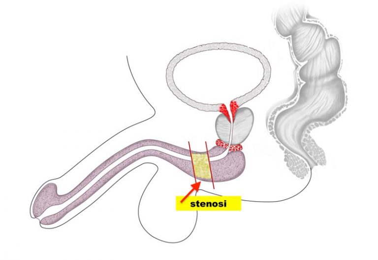 Stenosi uretrale - Fig. 1