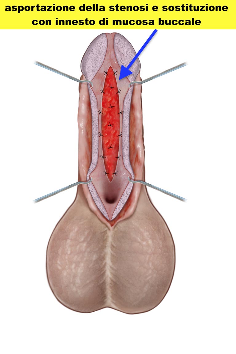 Stenosi uretrale - Fig. 10