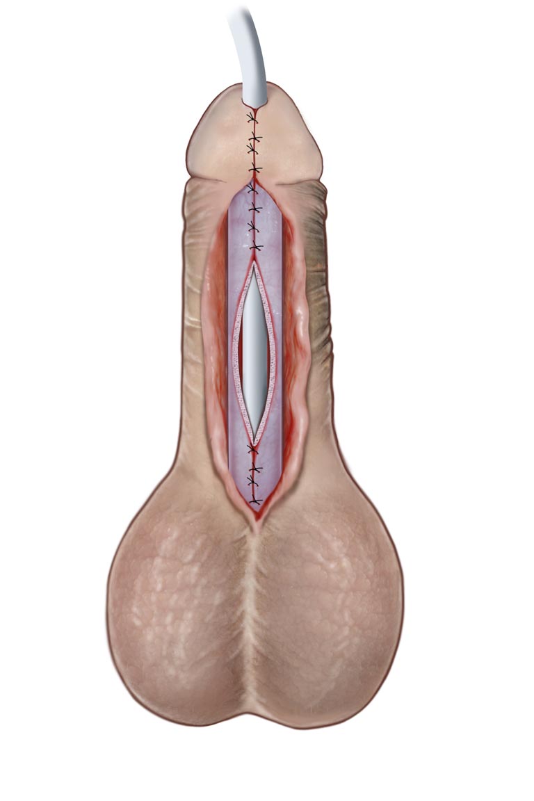 Stenosi uretrale - Fig. 11
