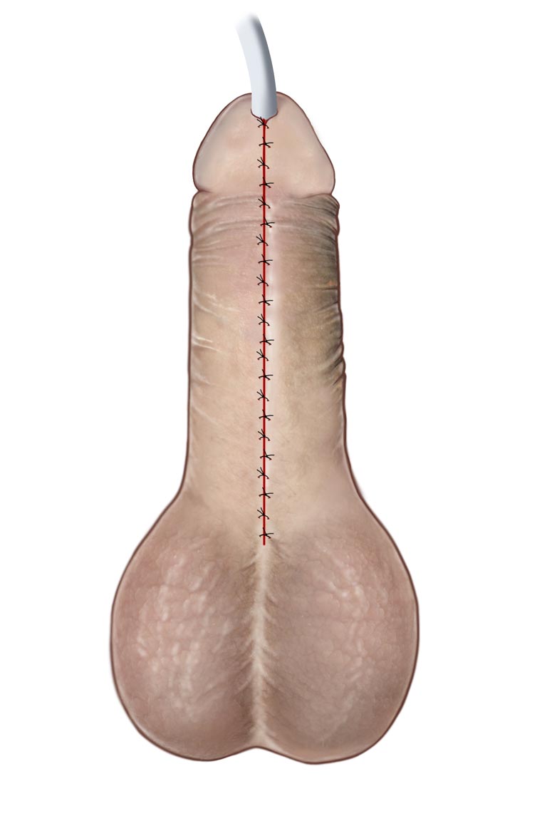 Stenosi uretrale - Fig. 12