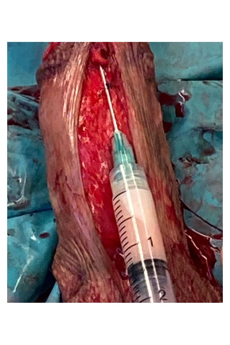 Stenosi uretrale - Fig. 13