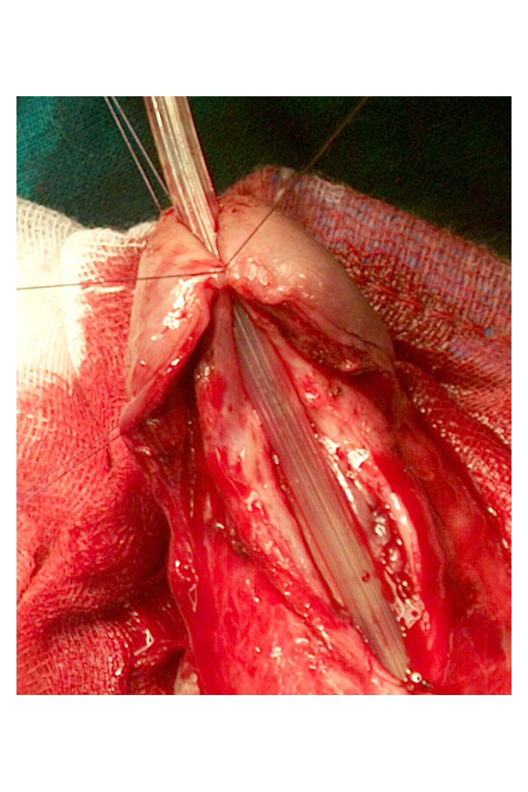 Stenosi uretrale - Fig. 14