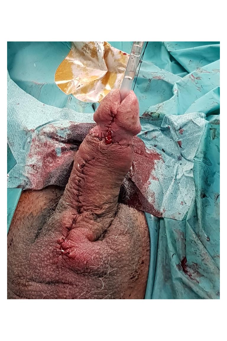Stenosi uretrale - Fig. 15
