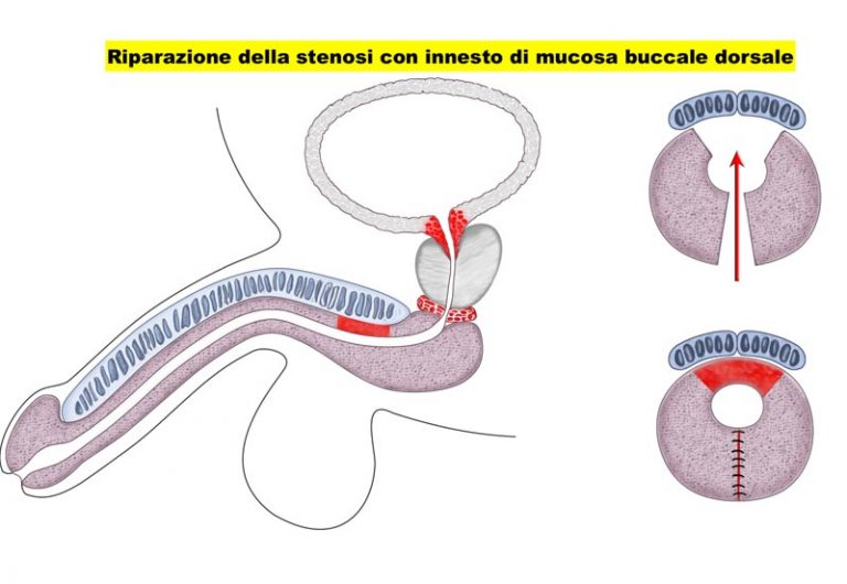 Stenosi uretrale - Fig. 2